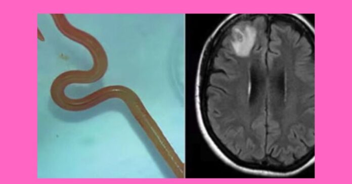 A living worm in Brain  சிறுவர்களுக்கான உலக செய்திகள்